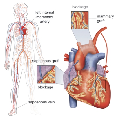 Coronary-Artery-Bypass